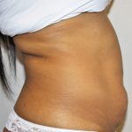 Tummy Tuck Before & After Patient #496