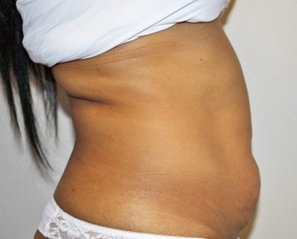 Tummy Tuck Before & After Patient #496