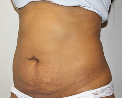 Tummy Tuck Before & After Patient #496