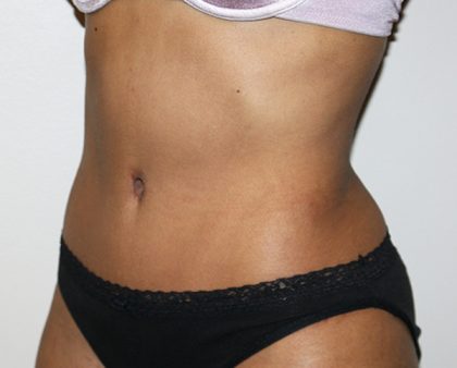 Tummy Tuck Before & After Patient #496