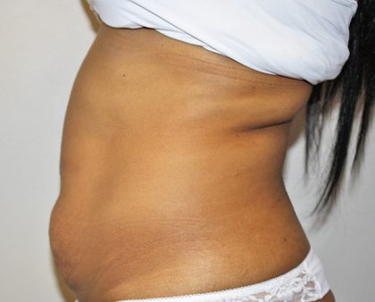 Tummy Tuck Before & After Patient #496