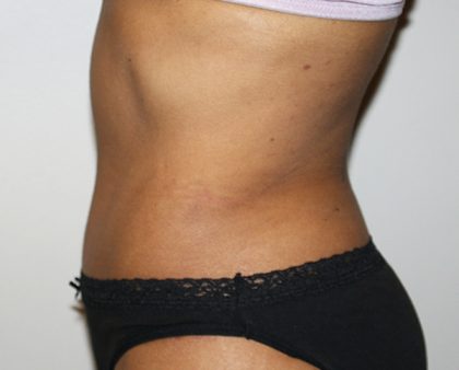 Tummy Tuck Before & After Patient #496