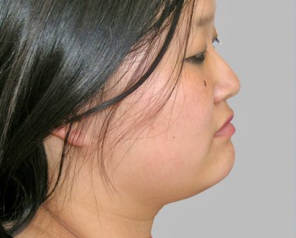 Neck Liposuction Before & After Patient #1173