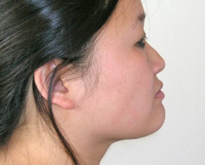 Neck Liposuction Before & After Patient #1173