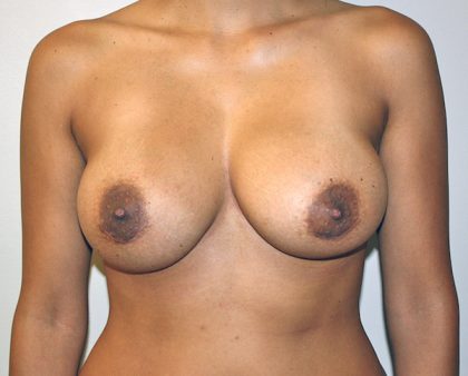 Breast Revision Before & After Patient #1031