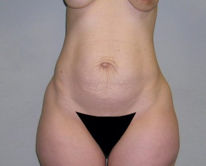 Tummy Tuck Before & After Patient #482