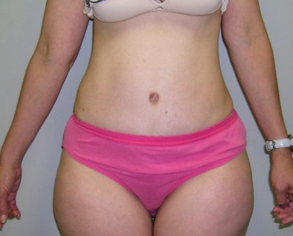 Tummy Tuck Before & After Patient #482