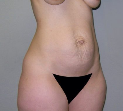 Tummy Tuck Before & After Patient #482