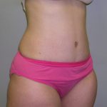 Tummy Tuck Before & After Patient #482