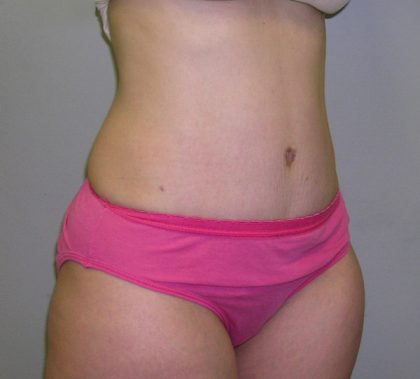 Tummy Tuck Before & After Patient #482