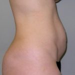 Tummy Tuck Before & After Patient #482