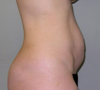 Tummy Tuck Before & After Patient #482
