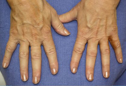 Hand Rejuvenation Before & After Patient #1090