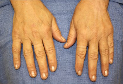 Hand Rejuvenation Before & After Patient #1090
