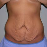 Tummy Tuck Before & After Patient #620