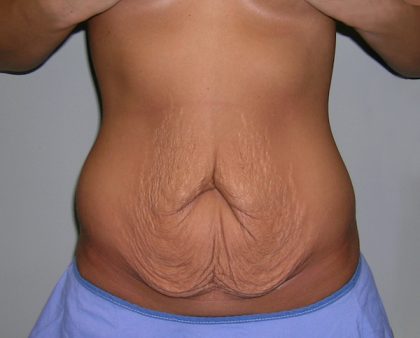 Tummy Tuck Before & After Patient #620