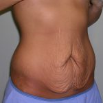 Tummy Tuck Before & After Patient #620