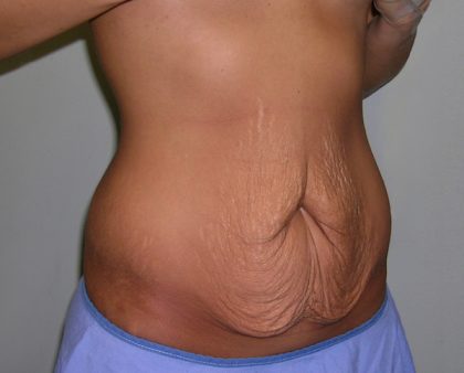 Tummy Tuck Before & After Patient #620