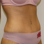 Tummy Tuck Before & After Patient #620