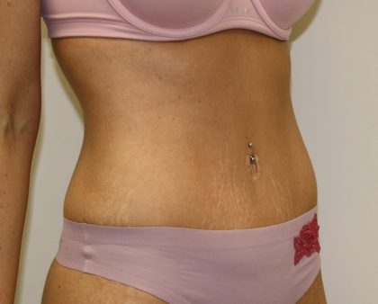 Tummy Tuck Before & After Patient #620