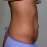 Tummy Tuck Before & After Patient #620