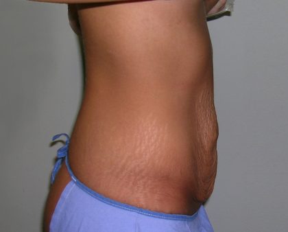 Tummy Tuck Before & After Patient #620