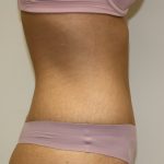 Tummy Tuck Before & After Patient #620