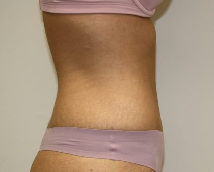 Tummy Tuck Before & After Patient #620