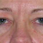 Blepharoplasty Before & After Patient #736