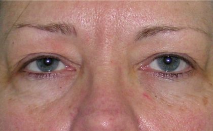 Blepharoplasty Before & After Patient #736