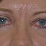 Blepharoplasty Before & After Patient #736