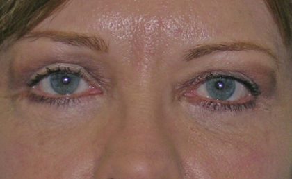 Blepharoplasty Before & After Patient #736