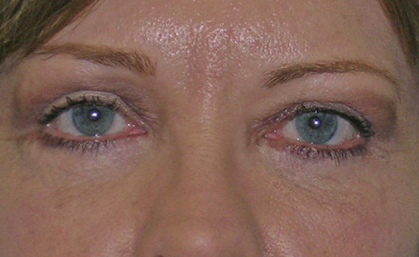 Blepharoplasty Before & After Patient #736