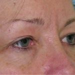 Blepharoplasty Before & After Patient #736