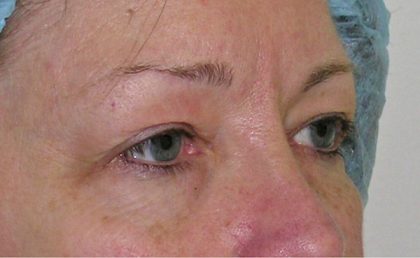 Blepharoplasty Before & After Patient #736