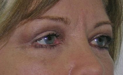 Blepharoplasty Before & After Patient #736