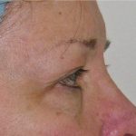 Blepharoplasty Before & After Patient #736