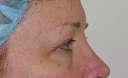 Blepharoplasty Before & After Patient #736