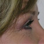 Blepharoplasty Before & After Patient #736