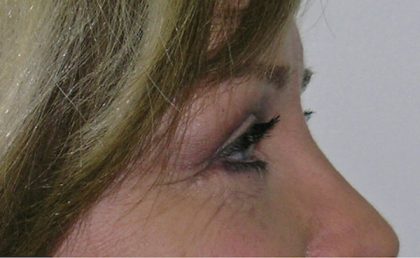 Blepharoplasty Before & After Patient #736