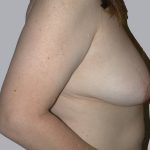 Breast Lift Before & After Patient #834