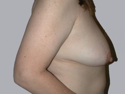 Breast Lift Before & After Patient #834