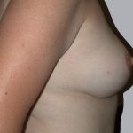Breast Lift Before & After Patient #834