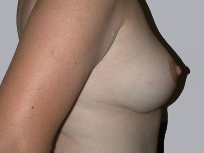 Breast Lift Before & After Patient #834