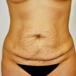 Tummy Tuck Before & After Patient #642