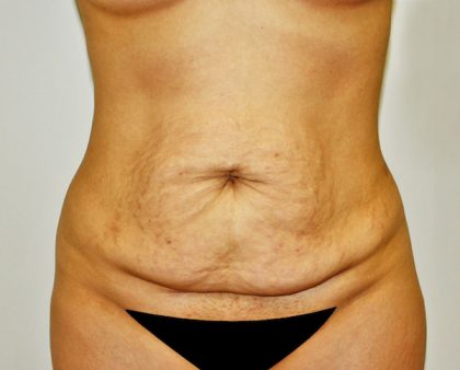 Tummy Tuck Before & After Patient #642