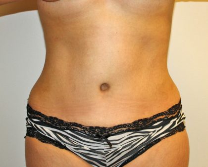 Tummy Tuck Before & After Patient #642