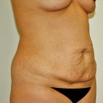Tummy Tuck Before & After Patient #642