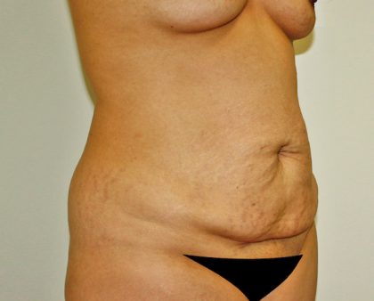 Tummy Tuck Before & After Patient #642