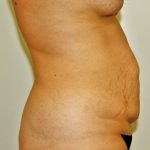 Tummy Tuck Before & After Patient #642